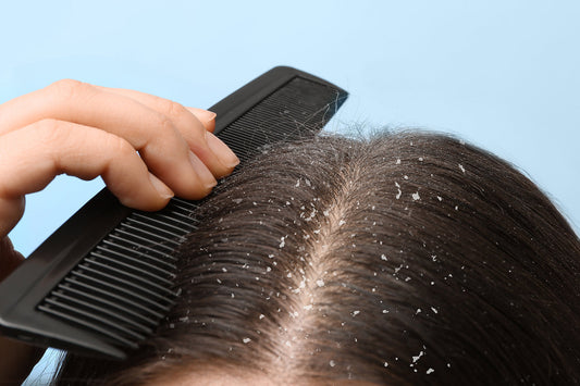 How-to-Remove-Dandruff